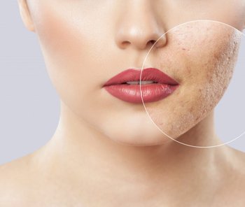 Acne scar