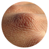 Cracked skin