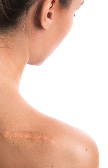 Keloid