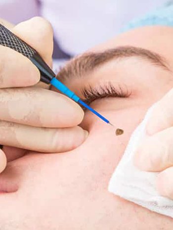 Mole removal