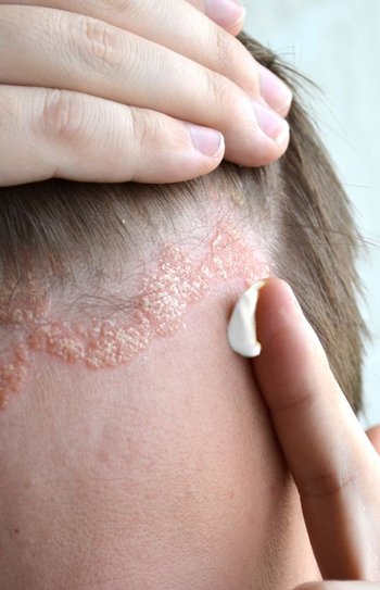 Psoriasis