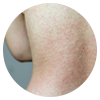 Rash