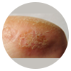 Scaling or flaking of skin