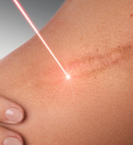 Scar removal