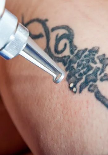 Tatoo removal