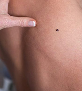 Wart  extraction